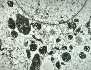 F,17y. | megamitochondria - Wilson disease F,17y. | megamitochondria - Wilson disease